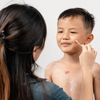 cara mengobati cacar air pada anak