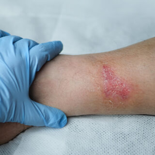 Cara Menghilangkan Bekas Luka di Kaki