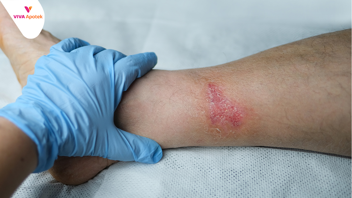 Begini Cara Menghilangkan Bekas Luka di Kaki Viva Apotek