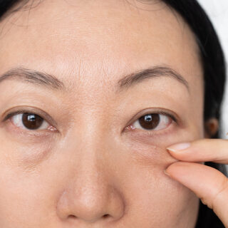 Cara Menghilangkan Kantung Mata