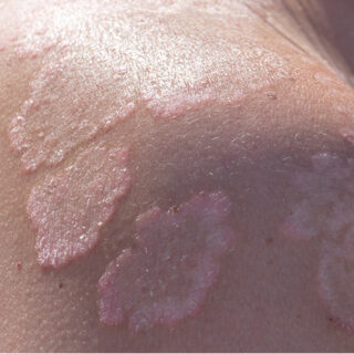 Cara Menghilangkan Panu