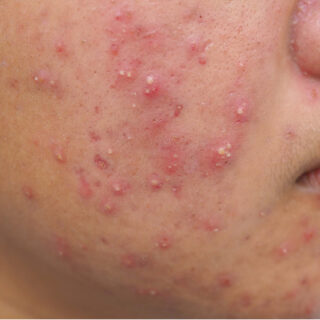 Penyebab Jerawat di Pipi