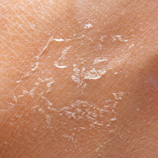 cara mengatasi kulit kering