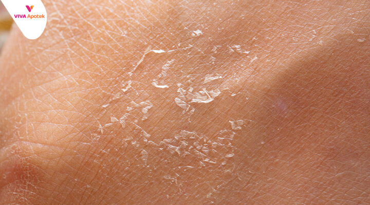 cara mengatasi kulit kering
