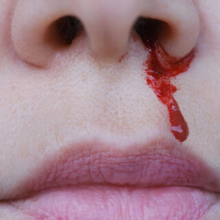 cara mengatasi mimisan