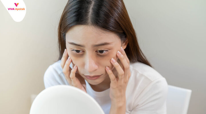 cara menghilangkan mata sembab