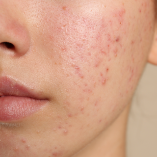 kenapa muka bruntusan