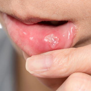 kenapa sariawan perih