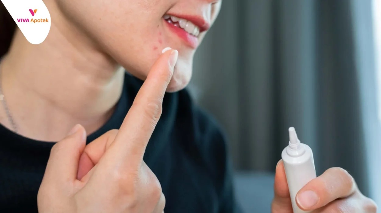 Obat Jerawat di Apotek