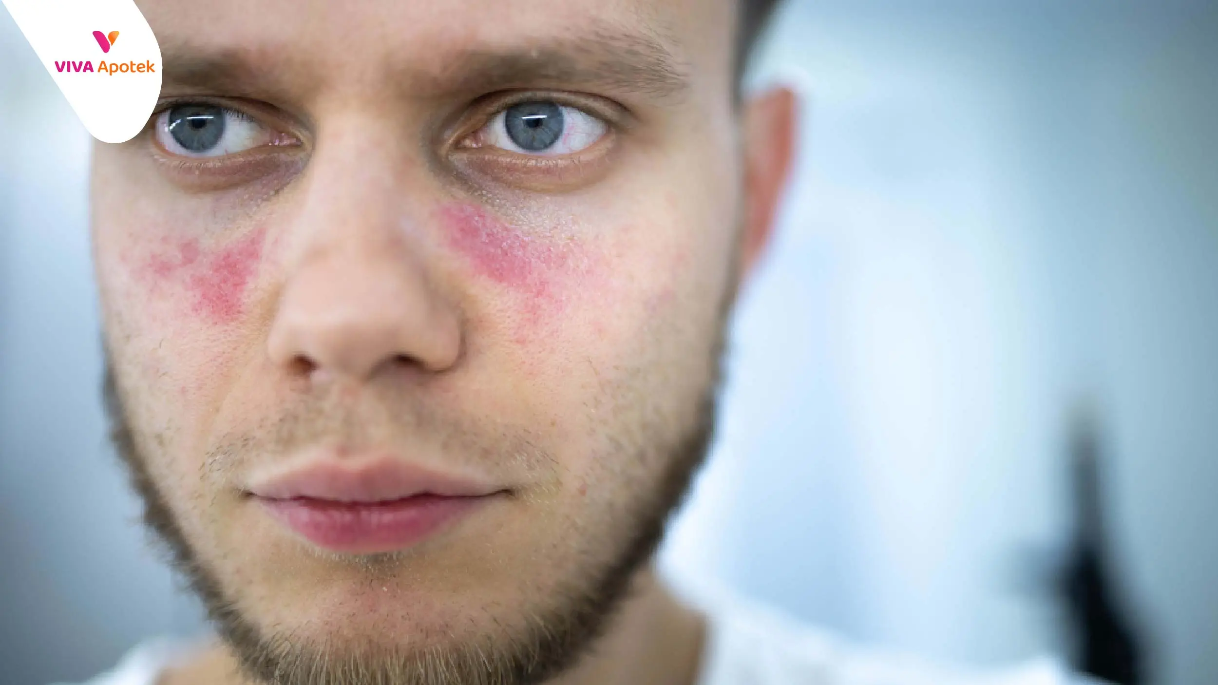 Pengertian Lupus Adalah