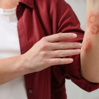 kandungan untuk memudarkan bekas luka