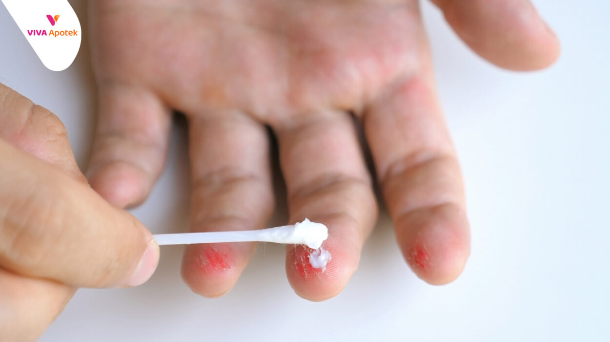 langkah tepat merawat luka baru