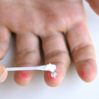 langkah tepat merawat luka baru