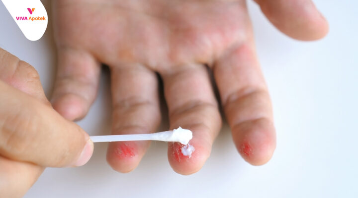 langkah tepat merawat luka baru