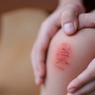 panduan perlindungan untuk luka kecil