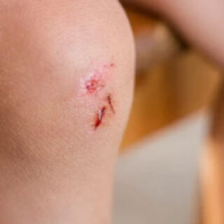 risiko infeksi pada luka kecil