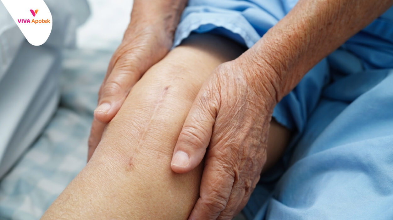 tips menghilangkan bekas luka operasi