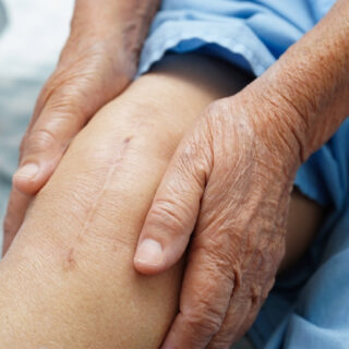 tips menghilangkan bekas luka operasi