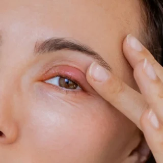 cara mengatasi bintitan