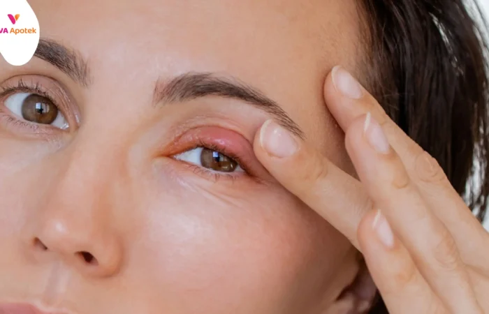 cara mengatasi bintitan