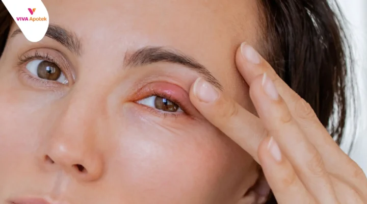 cara mengatasi bintitan