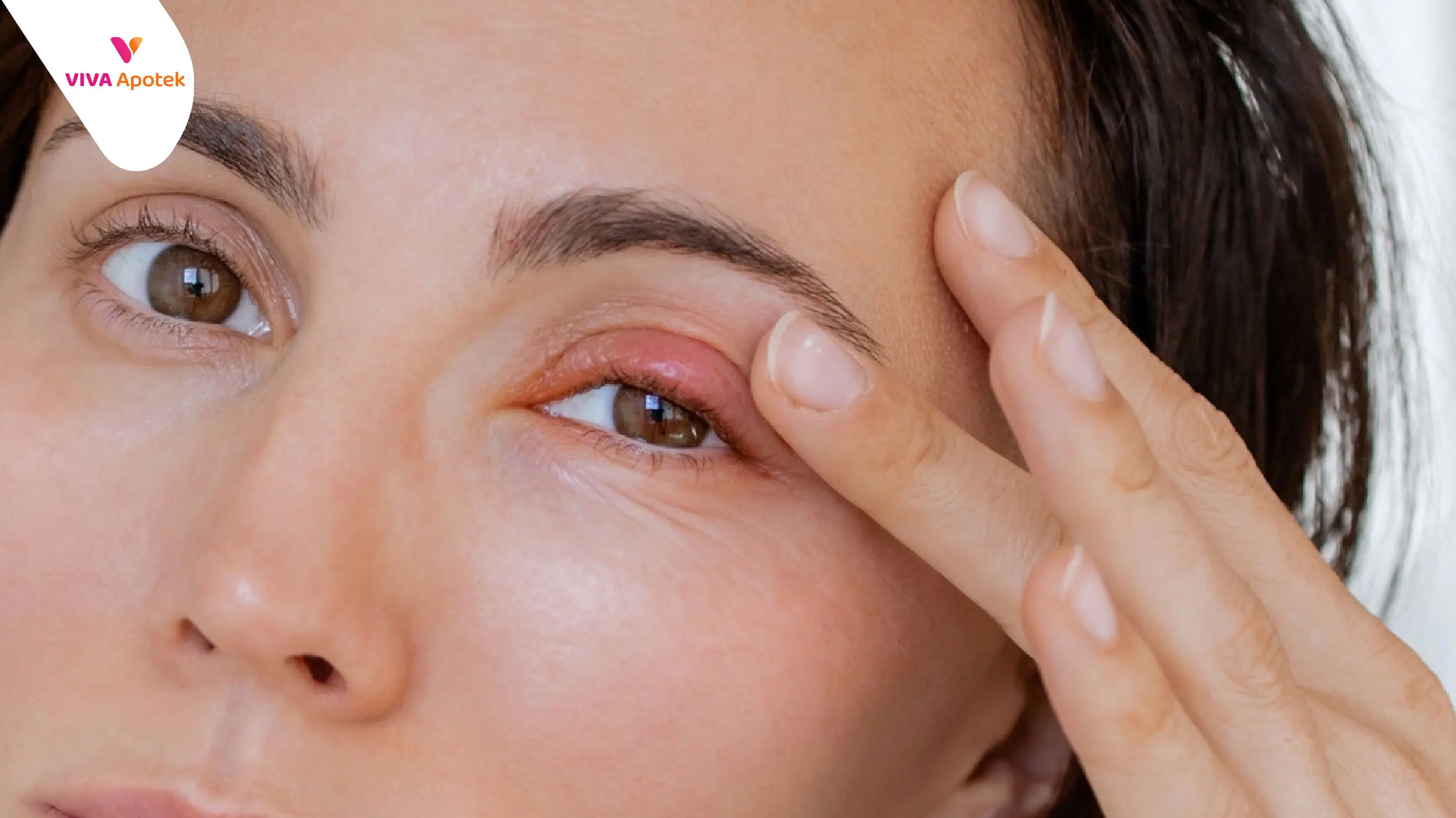 cara mengatasi bintitan