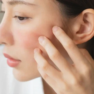 cara menghilangkan bekas jerawat merah