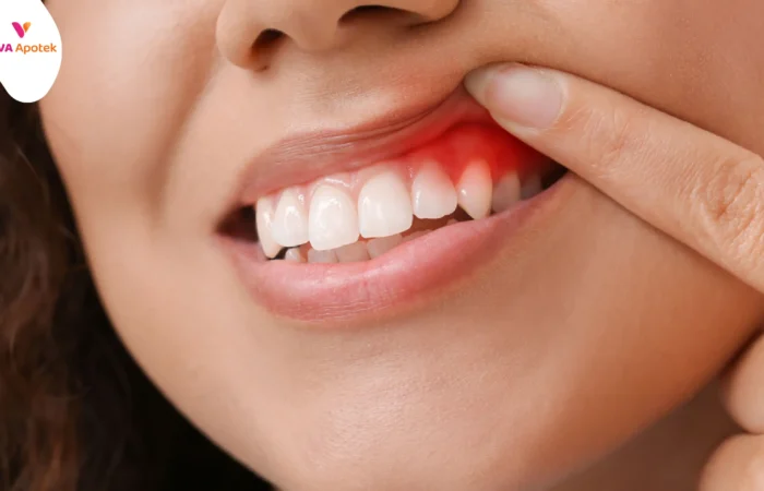 cara mengobati sakit gigi gusi bengkak
