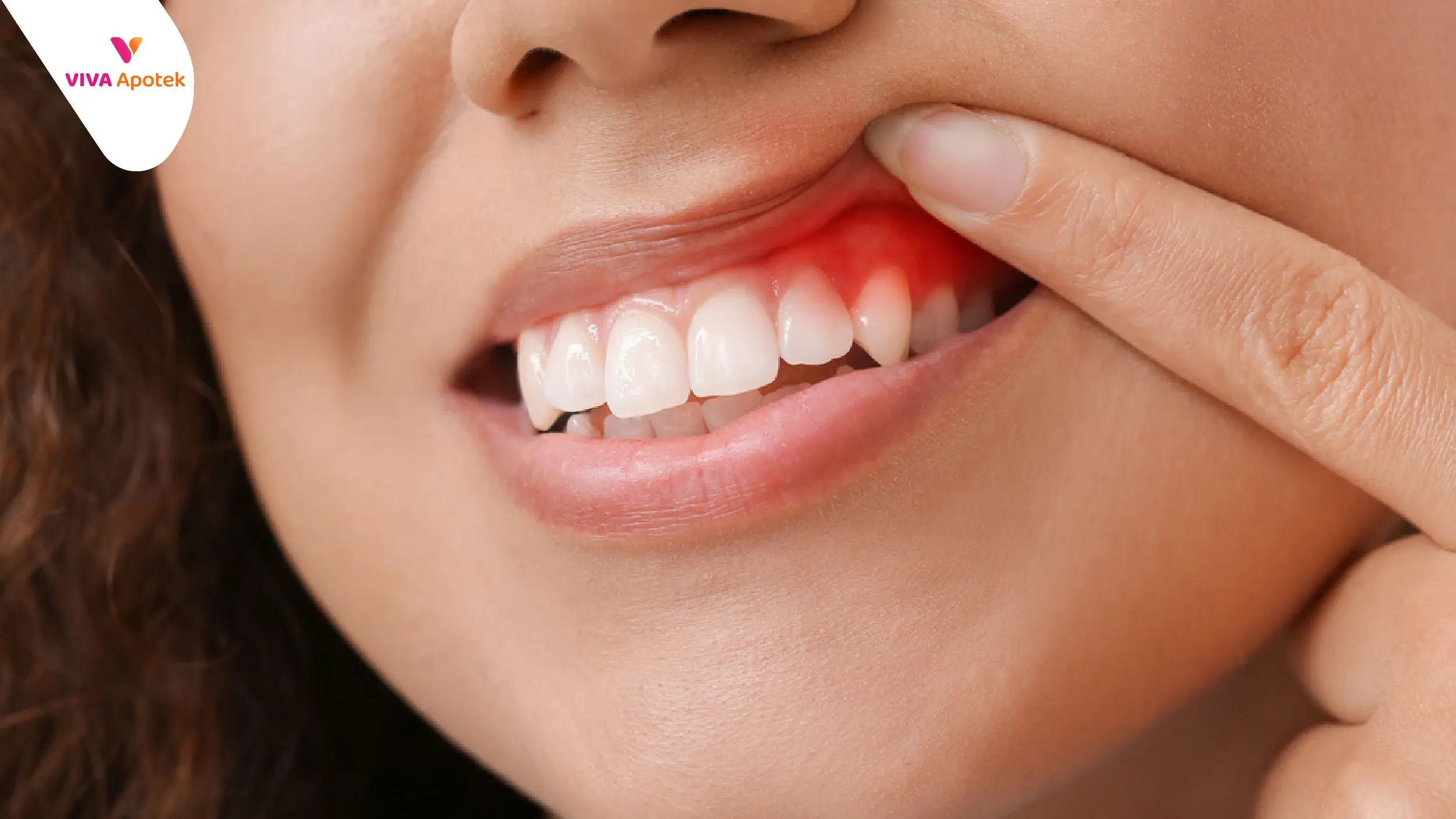 cara mengobati sakit gigi gusi bengkak