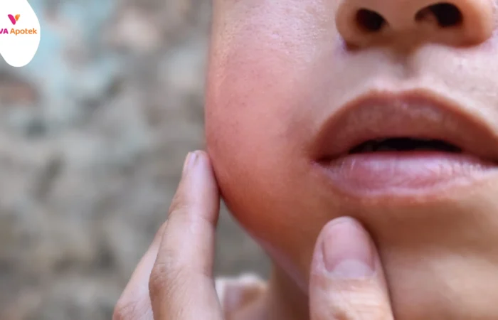 kenapa gondongan tak kunjung kempes