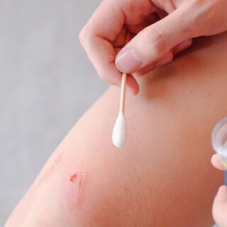 apakah alkohol aman untuk membersihkan luka