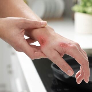 cara agar luka cepat kering