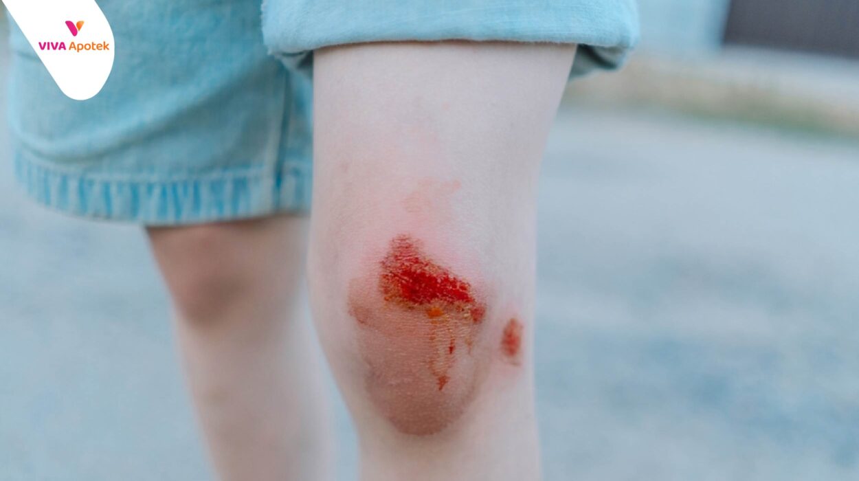 cara mengobati luka berair agar cepat kering