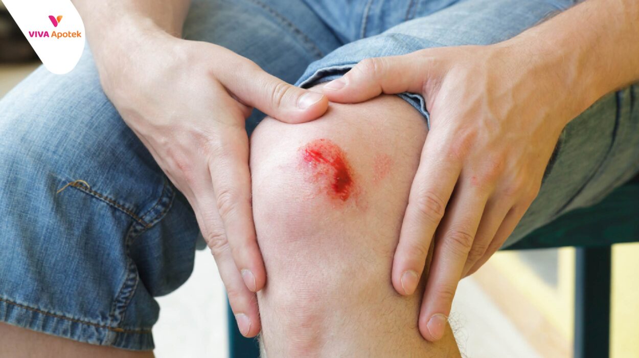 cara mengobati lutut luka berdarah jatuh dari motor