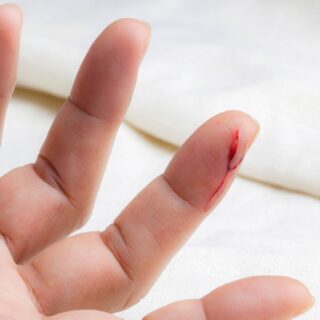 cara mengobati tangan luka kena pisau silet