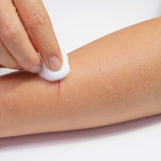 langkah membersihkan luka agar tidak perih