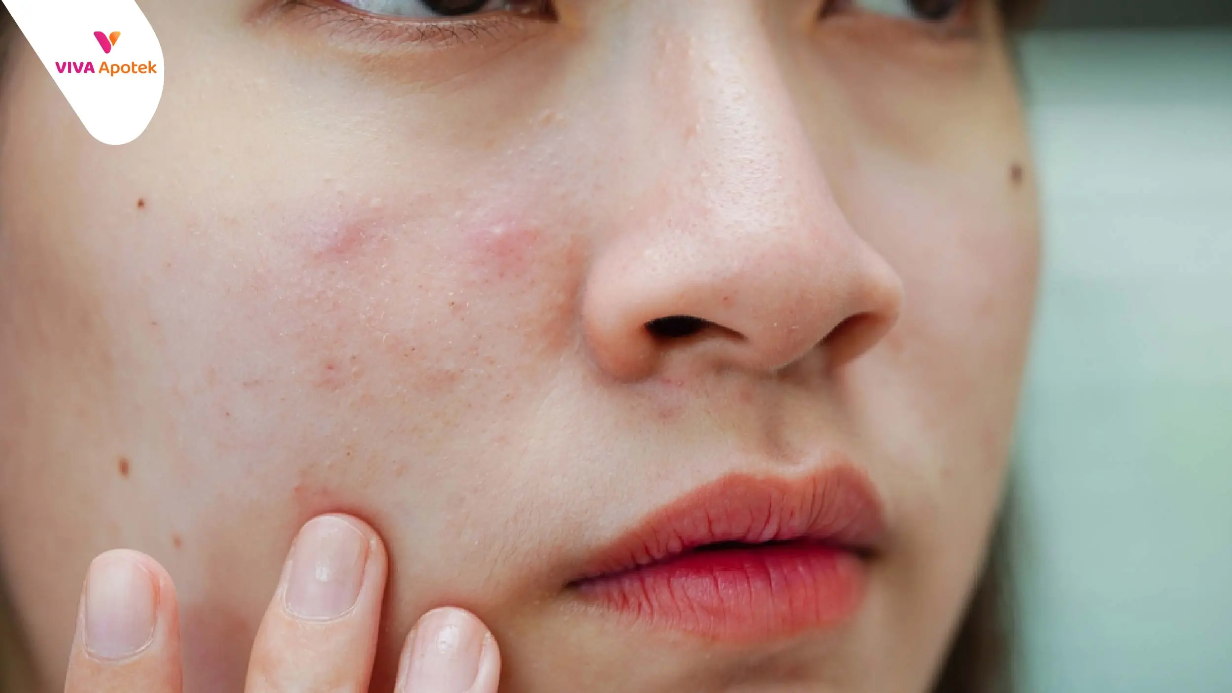 Cara Menghilangkan Bruntusan di Wajah Secara Alami