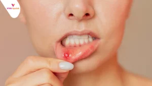 Daftar dan Harga Obat Sariawan di Apotek