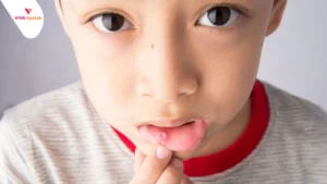 Daftar dan Harga Obat Sariawan Anak di Apotek