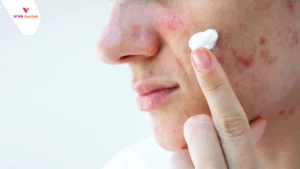 Daftar dan Harga Obat Totol Jerawat di Apotek