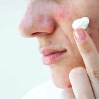 Daftar dan Harga Obat Totol Jerawat di Apotek
