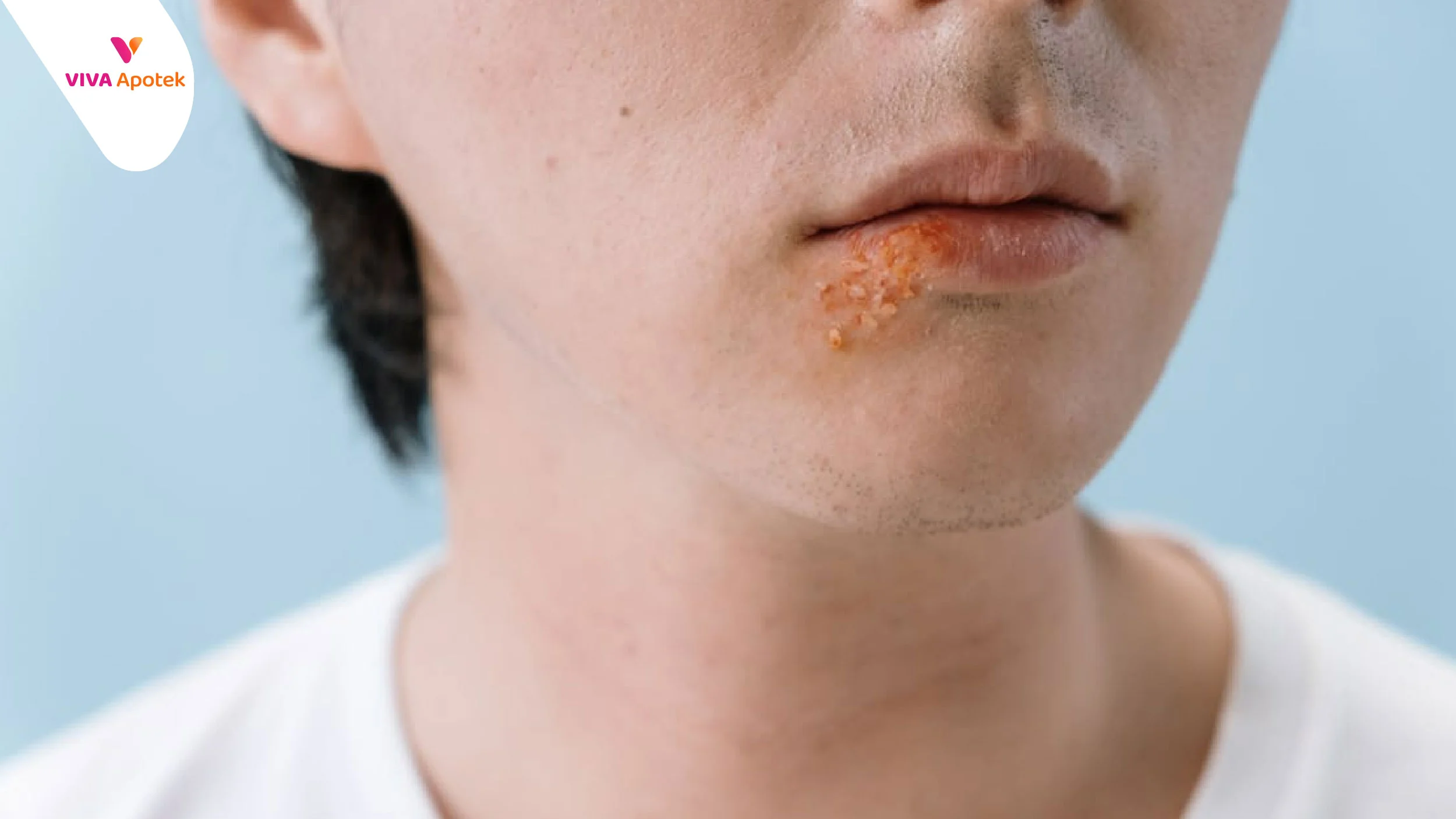 Impetigo