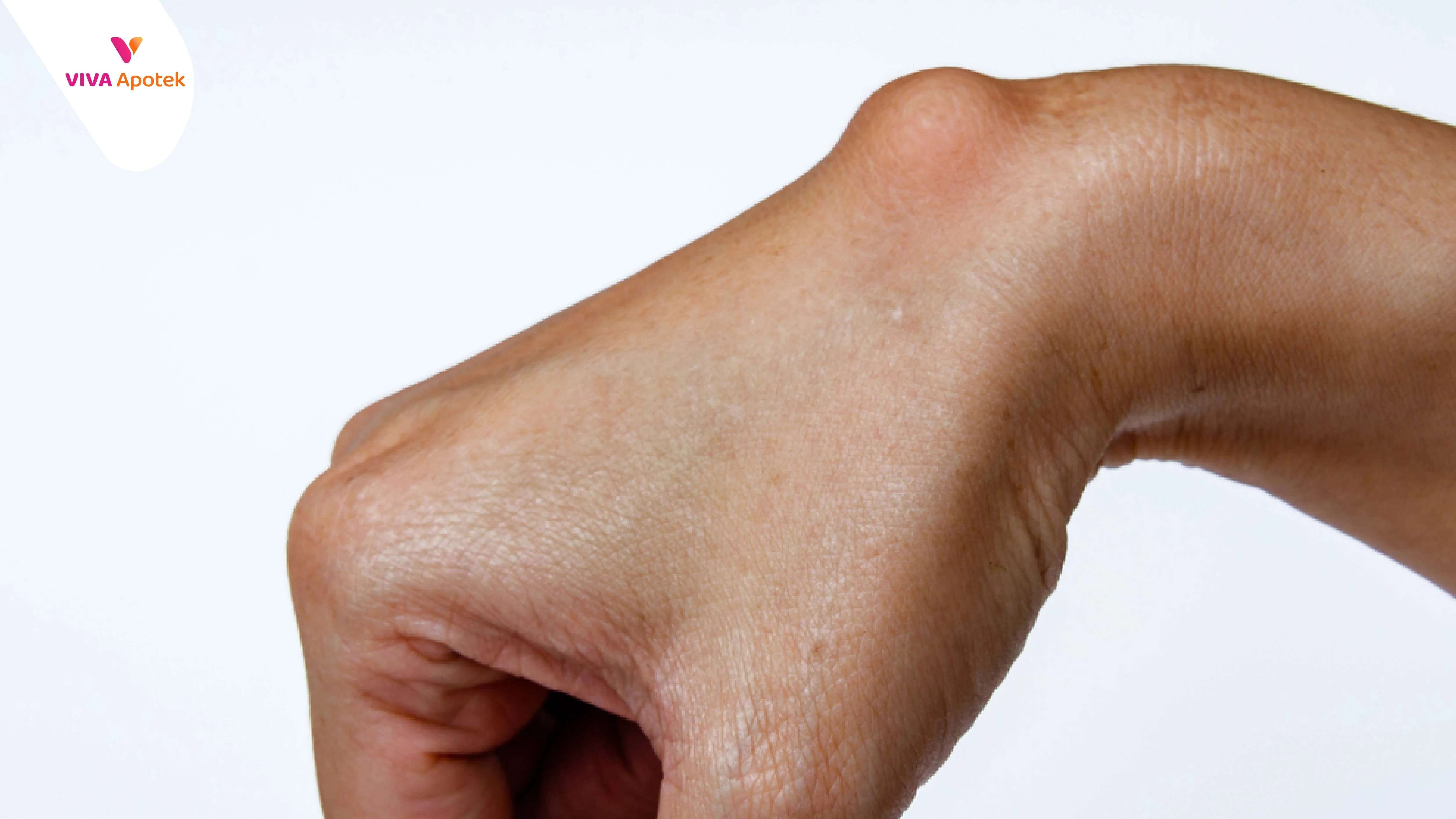 Kista Ganglion